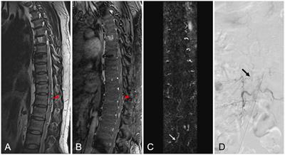 MRI characteristics of lumbosacral dural arteriovenous fistulas